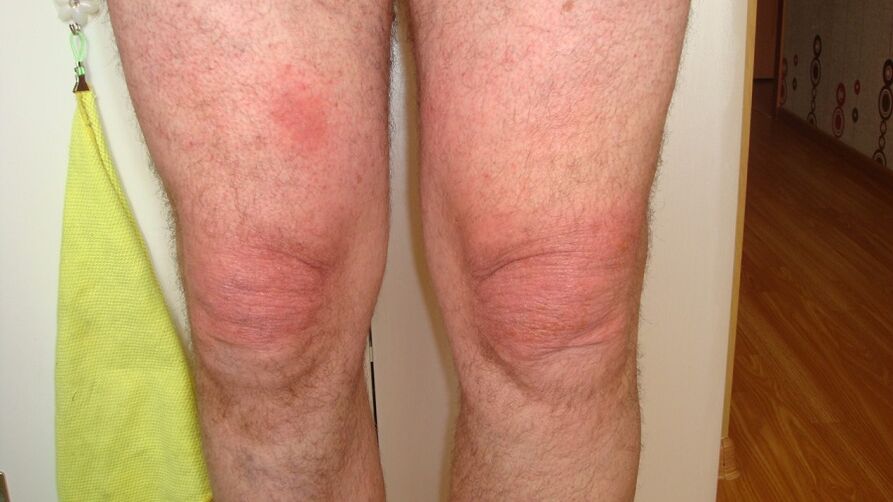 Οστεοαρθρίτιδα των αρθρώσεων του γόνατος