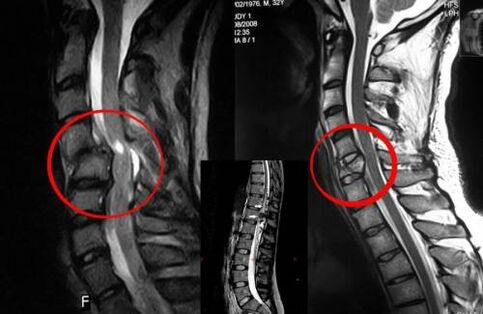 Συμπίεση του νωτιαίου μυελού – ένδειξη για χειρουργική επέμβαση